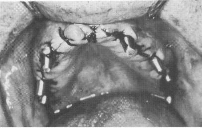 1 Tissues closed with surgical ties after insertion of dental blades 