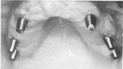 2 Healed maxillary tissues two weeks after blade implants insertion