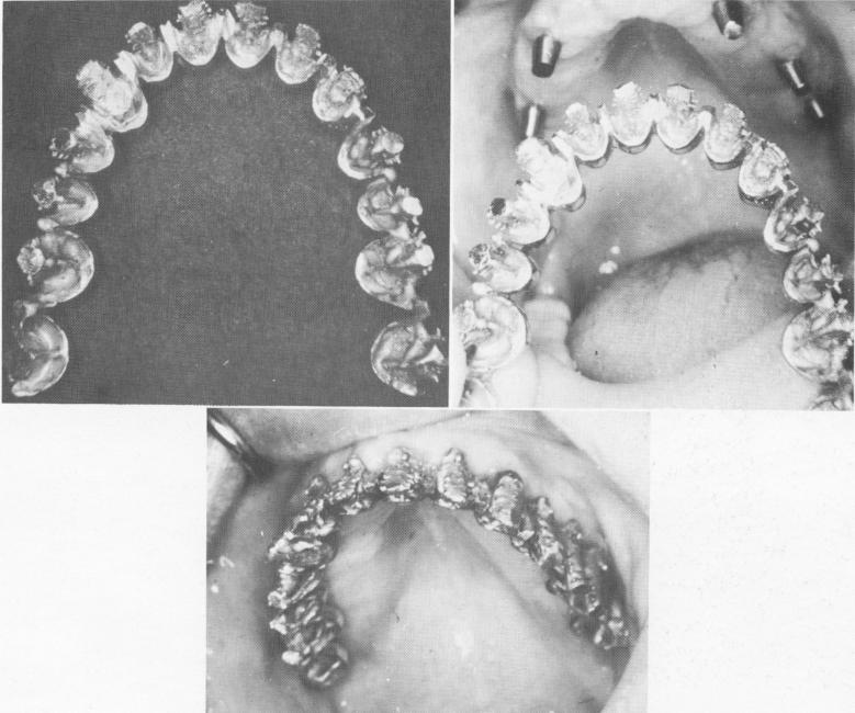 3 One piece gold casting for maxillary acrylic prosthesis