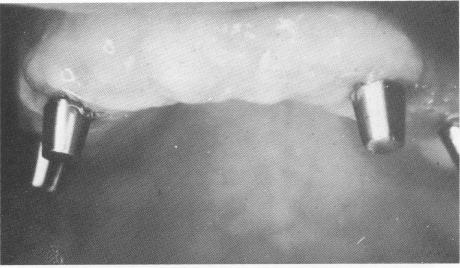 1 Close view of healed maxillary tissue before final prosthesis inserted