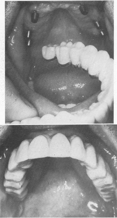 2 Full maxillary arch fixed denture, made of acrylic over gold in place