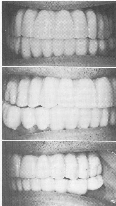 3 Final maxillary prosthesis articulated