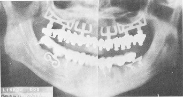 1 Preoperative view of patient`s existing teeth and prosthesis