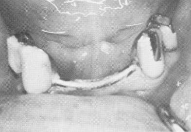 2 Blade implants placed in edentulous maxilla and sutured