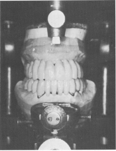 1 Dental case articulated on Hanau articulator