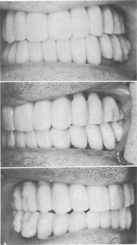 3 Maxillary and mandibular prostheses articulated