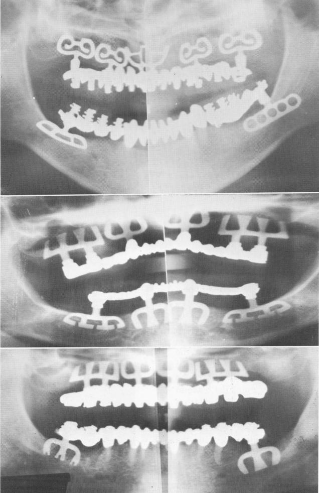 1 Panorex of finished maxillary and mandibular prosthesis in place