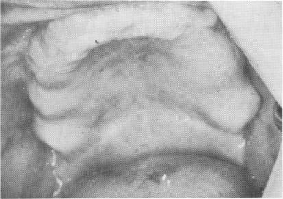 1 Edentulous maxilla with very little bone below maxillary sinus