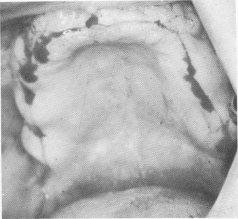 2 Incision made from retromolar area to retromolar area of maxilla