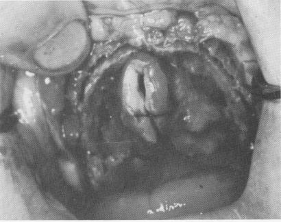 3 Underlying maxillary alveolar crest exposed and continuous groove made