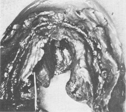 1 For accurate impression, elastic material forced into maxillary groove