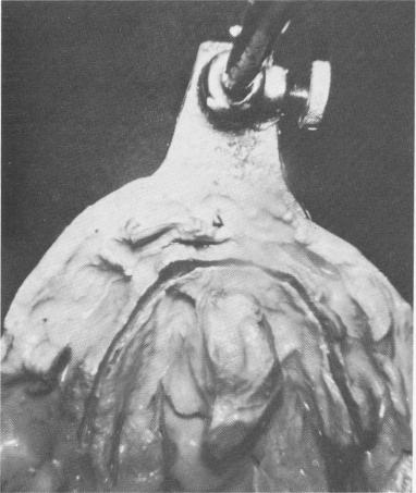 2 Groove deepened in stone model complying with xray interpretation