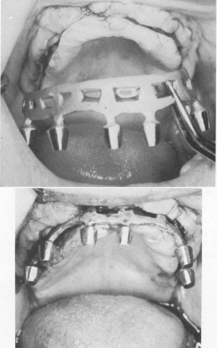3 One piece continuous blade inserted into groove in upper dental arch