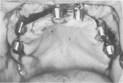 4 Dental blade tapped until its shoulder is little below alveolar crest