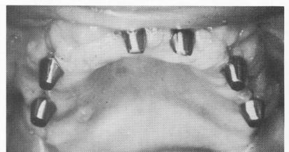 1 Tissues closed after blades inserted in maxillary arch