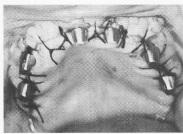 2 Healed site in maxilla after insertion of blade implants