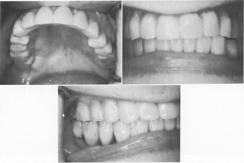 3 Completed maxillary acrylic prosthesis cemented in place