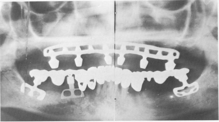 1 Panorex of completed maxillary restoration