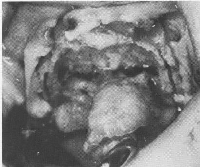 2 Edentulous maxilla with recent extractions shows irregular fibromucosa