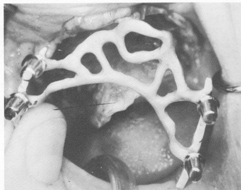 2 Tissues sutured after palatal horseshoe type blade inserted in maxilla