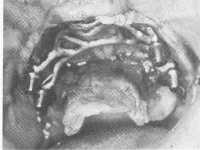 3 Maxillary acrylic full arch splint