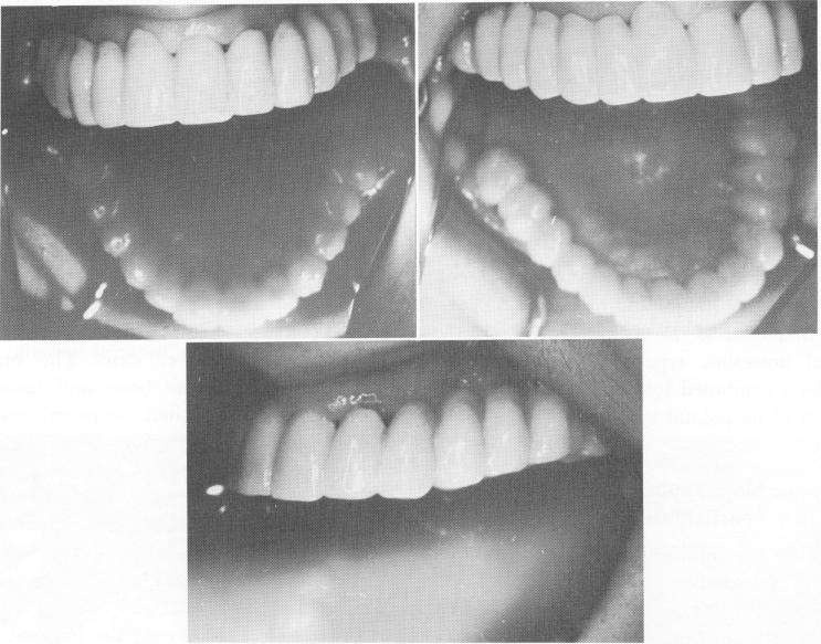 1 Splint cemented on maxillary arch