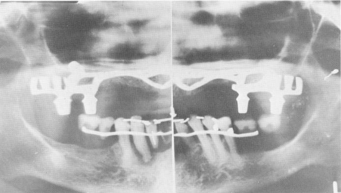2 Final Panorex after mandibular arch restoration
