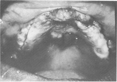 1 Incision made along fibromucosal tissue on edentulous maxillary ridge