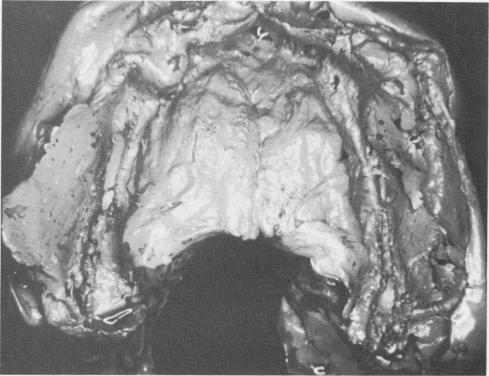 2 Elastic impression including exposed palate & posterior grooves made