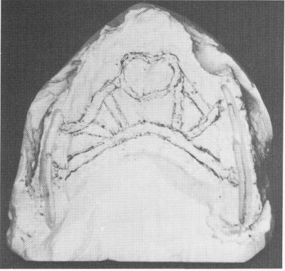 1 Completed casting over maxillary stone model 