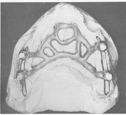 2 Implant inserted with close adaptation to maxillary palate and grooves
