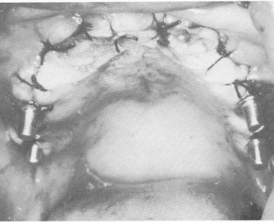 1 Completely healed tissue ten days after implant inserted in maxilla