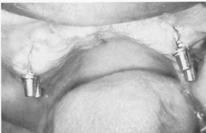 2 Palateless upper denture with anterior acrylic flange fabricated 