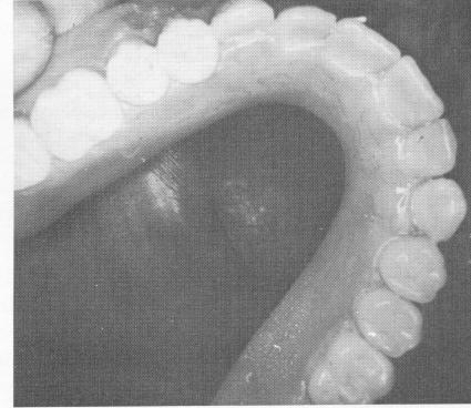 3 Palateless upper denture in position