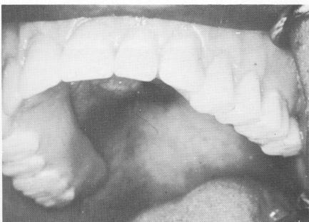 4 Palateless upper denture carefully articulated and balanced