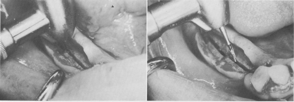 2 700L fissure bur used to prepare grooves to set blades in jaw bone