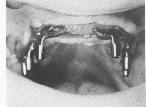 1 Nearly perfect parallelism achieved easily with dental blade implants