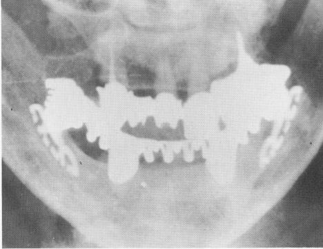 2 Roentgenogram shows shoulders of blade buried below alveolar crest