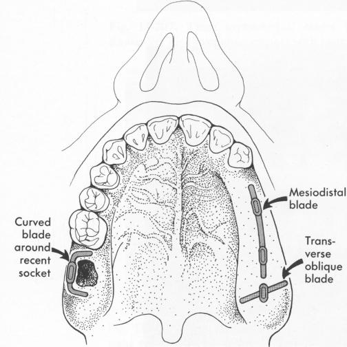 1 Occlusal view of maxilla showing many appropriate blade designs