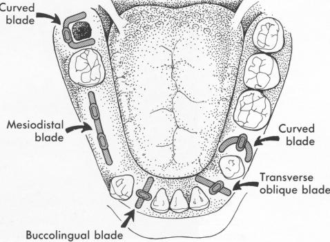 2 Occlusal view of mandible showing several types of blade designs