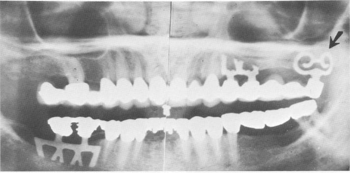 1 Panorex shows how three different blade designs suit their locations
