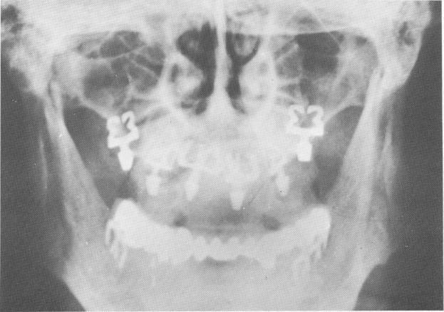 2 Posterior blades in maxillae set buccopalatally in tuberosities