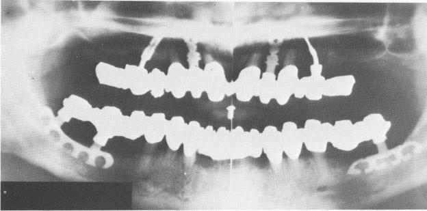 1 Asymmetrical blades designed to avoid penetrating maxillary sinuses