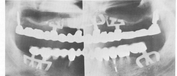 2 Series of blade implant designs in maxilla and mandible