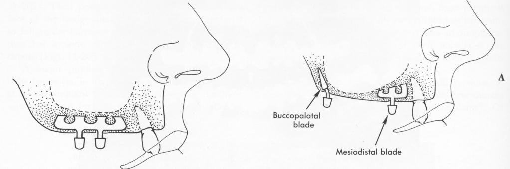 1 Double posted, mesiodistal blade below maxillary sinus floor