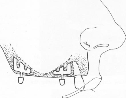 2 Specially designed blades used to avoid maxillary sinus penetration