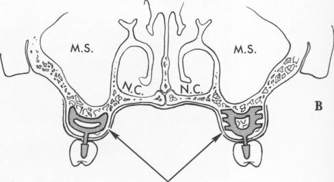 3 Buccopalatal blade used if there is very little bone distal to sinus