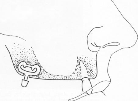4 One method of setting blade in maxillary tuberosity is mesiodistally