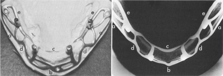 2 Substructure on master stone cast from Neoplex impression of mandible