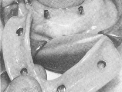 1 Mandibular superstructure framework processed inside implant denture